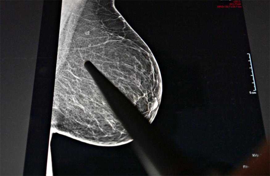 Häufigste Diagnose bei Frauen war Brustkrebs